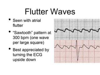 Flutter Waves
• Seen with atrial
flutter
• “Sawtooth” pattern at
300 bpm (one wave
per large square)
• Best appreciated by
turning the ECG
upside down
 