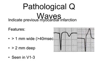 Pathological Q
WavesIndicate previous myocardial infarction
Features:
• > 1 mm wide (>40msec)
• > 2 mm deep
• Seen in V1-3
 