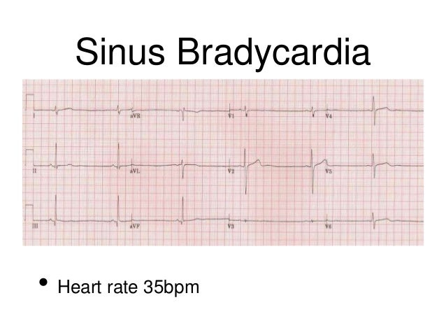 Ecg Analysis