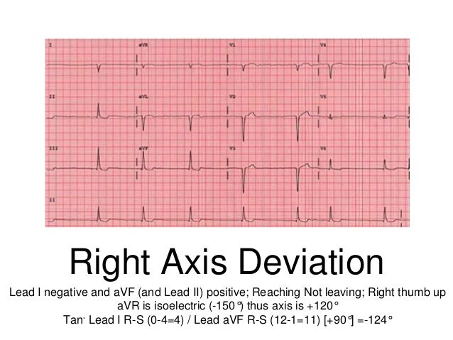 Right Axis Deviation Ecg Differential - Article Blog
