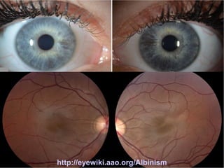 Síndrome de Chédiak-Higashi (SCH)

http://eyewiki.aao.org/Albinism

 