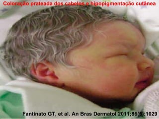 Coloração prateada dos cabelos e hipopigmentação cutânea

Síndrome de Chédiak-Higashi (SCH)

Fantinato GT, et al. An Bras Dermatol 2011;86(5):1029

 