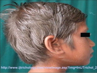 Síndrome de Chédiak-Higashi (SCH)

http://www.ijtrichology.com/viewimage.asp?img=IntJTrichol_20

 