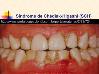 Síndrome de Chédiak-Higashi (SCH)
http://www.portalocupacional.com.br/portal/materias/2/28/724

 
