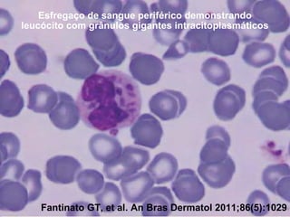Esfregaço de sangue periférico demonstrando
leucócito com grânulos gigantes intracitoplasmáticos

Síndrome de Chédiak-Higashi

Fantinato GT, et al. An Bras Dermatol 2011;86(5):1029

 