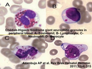 Chédiak-Higashi Sindrome giant azurophilic granules in
peripheral blood. A- Eosinophil; B- Lymphocyte; CNeutrophil; D- Monocyte

Azambuja AP et al. Rev Bras Hematol Hemoter.
2011;33(4):315

 