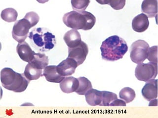 Síndrome de Chédiak-Higashi

Antunes H et al. Lancet 2013;382:1514

 