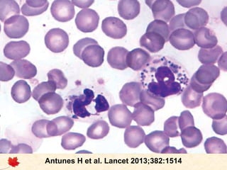 Síndrome de Chédiak-Higashi

Antunes H et al. Lancet 2013;382:1514

 