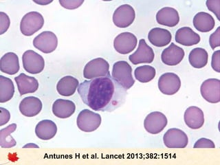Síndrome de Chédiak-Higashi

Antunes H et al. Lancet 2013;382:1514

 