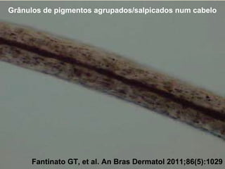 Grânulos de pigmentos agrupados/salpicados num cabelo

Síndrome de Chédiak-Higashi

Fantinato GT, et al. An Bras Dermatol 2011;86(5):1029

 