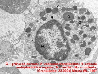Síndrome de Chédiak-Higashi (SCH)

G – grânulos densos; V- vesículas translúcidas; R- retículo
endoplasmático rugoso ; N – núcleo; Nu – nucléolo;
(Granulócito; 22.000x) Moura WL, 1997

 