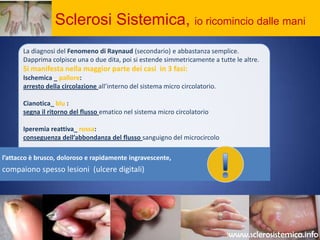 Sclerosi Sistemica, io ricomincio dalle maniLa diagnosi del Fenomeno di Raynaud (secondario) e abbastanza semplice.Dapprima colpisce una o due dita, poi si estende simmetricamente a tutte le altre. Si manifesta nella maggior parte dei casi  in 3 fasi:Ischemica _ pallore: arresto della circolazioneall’interno del sistema micro circolatorio.Cianotica_blu :segna il ritorno del flusso ematico nel sistema micro circolatorioIperemia reattiva_rossa:conseguenza dell’abbondanza del flussosanguigno del microcircolo     !www.sclerosistemica.info