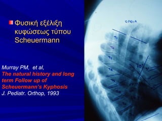 Φυσική εξέλιξηΦυσική εξέλιξη
κυφώσεως τύπουκυφώσεως τύπου
ScheuermannScheuermann
Murray PM, et al,
The natural history and long
term Follow up of
Scheuermann’s Kyphosis
J. Pediatr. Orthop, 1993
 