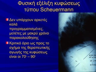 Φυσική εξέλιξη κυφώσεωςΦυσική εξέλιξη κυφώσεως
τύπουτύπου ScheuermannScheuermann
Δεν υπάρχουν αρκετέςΔεν υπάρχουν αρκετές
καλάκαλά
προγραμματισμένες,προγραμματισμένες,
μελέτες με μακρύ χρόνομελέτες με μακρύ χρόνο
παρακολούθησηςπαρακολούθησης
Κριτικό όριο ως προς τοΚριτικό όριο ως προς το
σχήμα της θεραπευτικήςσχήμα της θεραπευτικής
αγωγής της κυφώσεωςαγωγής της κυφώσεως
είναι οι 70είναι οι 70οο
– 90– 90οο
 