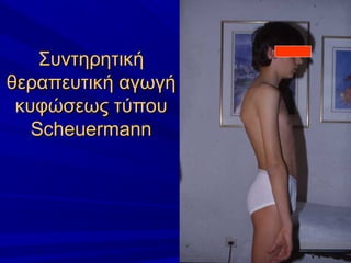 ΣυντηρητικήΣυντηρητική
θεραπευτική αγωγήθεραπευτική αγωγή
κυφώσεως τύπουκυφώσεως τύπου
ScheuermannScheuermann
 
