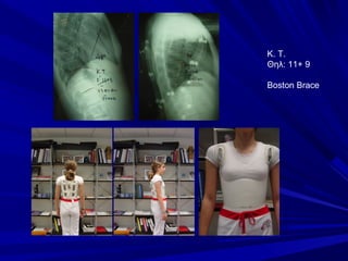K. T.
Θηλ: 11+ 9
Boston Brace
 