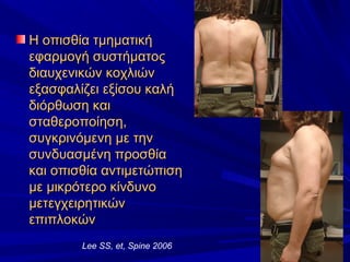 Η οπισθία τμηματικήΗ οπισθία τμηματική
εφαρμογή συστήματοςεφαρμογή συστήματος
διαυχενικών κοχλιώνδιαυχενικών κοχλιών
εξασφαλίζει εξίσου καλήεξασφαλίζει εξίσου καλή
διόρθωση καιδιόρθωση και
σταθεροποίηση,σταθεροποίηση,
συγκρινόμενη με τηνσυγκρινόμενη με την
συνδυασμένη προσθίασυνδυασμένη προσθία
και οπισθία αντιμετώπισηκαι οπισθία αντιμετώπιση
με μικρότερο κίνδυνομε μικρότερο κίνδυνο
μετεγχειρητικώνμετεγχειρητικών
επιπλοκώνεπιπλοκών
Lee SS, et, Spine 2006
 