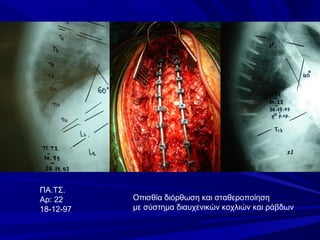 ΠΑ.ΤΣ.
Αρ: 22
18-12-97
Οπισθία διόρθωση και σταθεροποίηση
με σύστημα διαυχενικών κοχλιών και ράβδων
 
