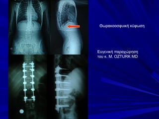 Ευγενική παραχώρηση
του κ. M. OZTURK MD
Θωρακοοσφυική κύφωση
 