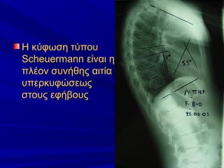 Η κύφωση τύπουΗ κύφωση τύπου
ScheuermannScheuermann είναι ηείναι η
πλέον συνήθης αιτίαπλέον συνήθης αιτία
υπερκυφώσεωςυπερκυφώσεως
στους εφήβουςστους εφήβους
 