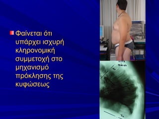 Φαίνεται ότιΦαίνεται ότι
υπάρχει ισχυρήυπάρχει ισχυρή
κληρονομικήκληρονομική
συμμετοχή στοσυμμετοχή στο
μηχανισμόμηχανισμό
πρόκλησης τηςπρόκλησης της
κυφώσεωςκυφώσεως
 