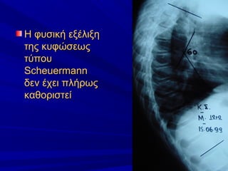 Η φυσική εξέλιξηΗ φυσική εξέλιξη
της κυφώσεωςτης κυφώσεως
τύπουτύπου
ScheuermannScheuermann
δεν έχει πλήρωςδεν έχει πλήρως
καθοριστείκαθοριστεί
 