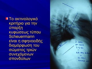 Το ακτινολογικόΤο ακτινολογικό
κριτήριο για τηνκριτήριο για την
ύπαρξηύπαρξη
κυφώσεως τύπουκυφώσεως τύπου
ScheuermannScheuermann
είναι η σφηνοειδήςείναι η σφηνοειδής
διαμόρφωση τουδιαμόρφωση του
σώματος τριώνσώματος τριών
συνεχόμενωνσυνεχόμενων
σπονδύλωνσπονδύλων
 