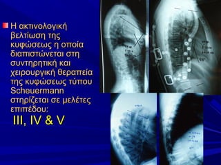 Η ακτινολογικήΗ ακτινολογική
βελτίωση τηςβελτίωση της
κυφώσεως η οποίακυφώσεως η οποία
διαπιστώνεται στηδιαπιστώνεται στη
συντηρητική καισυντηρητική και
χειρουργική θεραπείαχειρουργική θεραπεία
της κυφώσεως τύπουτης κυφώσεως τύπου
ScheuermannScheuermann
στηρίζεται σε μελέτεςστηρίζεται σε μελέτες
επιπέδουεπιπέδου::
III, IV & VIII, IV & V
 