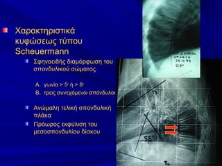 ΧαρακτηριστικάΧαρακτηριστικά
κυφώσεως τύπουκυφώσεως τύπου
ScheuermannScheuermann
Σφηνοειδής διαμόρφωση τουΣφηνοειδής διαμόρφωση του
σπονδυλικού σώματοςσπονδυλικού σώματος
A.A. γωνία > 5γωνία > 5οο
ή > 8ή > 8οο
B.B. τρεις συνεχόμενοι σπόνδυλοιτρεις συνεχόμενοι σπόνδυλοι
Ανώμαλη τελική σπονδυλικήΑνώμαλη τελική σπονδυλική
πλάκαπλάκα
Πρόωρος εκφύλιση τουΠρόωρος εκφύλιση του
μεσοσπονδυλίου δίσκουμεσοσπονδυλίου δίσκου
 
