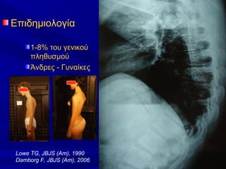 ΕπιδημιολογίαΕπιδημιολογία
1-8% του γενικού1-8% του γενικού
πληθυσμούπληθυσμού
Άνδρες - ΓυναίκεςΆνδρες - Γυναίκες
Lowe TG, JBJS (Am), 1990
Damborg F, JBJS (Am), 2006
 