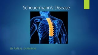 Scheuermann’s Disease
BY RAFI AL-SHAMRANI
 