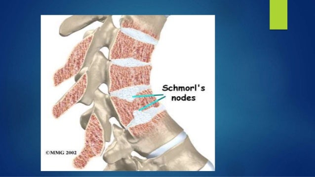 Scheuermann's disease