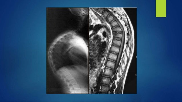 Scheuermann's disease