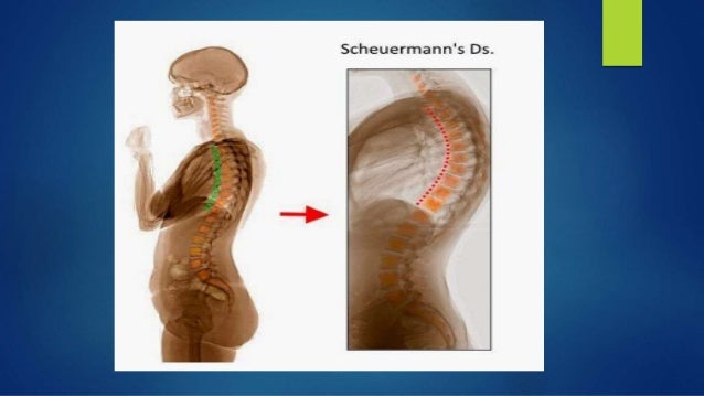 Scheuermann's disease