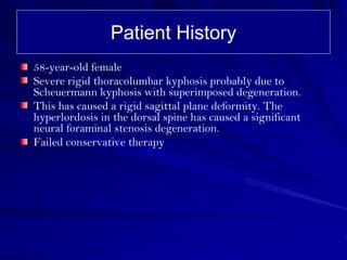 Patient History
58-year-old female
Severe rigid thoracolumbar kyphosis probably due to
Scheuermann kyphosis with superimposed degeneration.
This has caused a rigid sagittal plane deformity. The
hyperlordosis in the dorsal spine has caused a significant
neural foraminal stenosis degeneration.
Failed conservative therapy
 