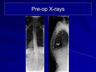 Pre-op X-rays




         70°
 