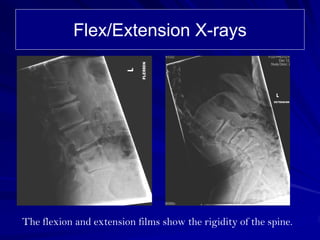 Flex/Extension X-rays




The flexion and extension films show the rigidity of the spine.
 