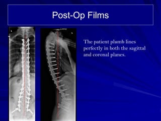 Post-Op Films

       The patient plumb lines
       perfectly in both the sagittal
       and coronal planes.
 