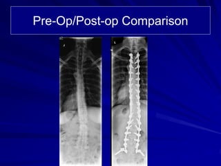 Pre-Op/Post-op Comparison
 