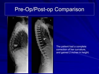 Pre-Op/Post-op Comparison




          0°

70°            The patient had a complete
               correction of her curvature,
               and gained 2 inches in height.
 