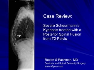 Case Review:
      Severe Scheurmann’s
      Kyphosis treated with a
70°
      Posterior Spinal Fusion
      from T2-Pelvis




      Robert S Pashman, MD
      Scoliosis and Spinal Deformity Surgery
      www.eSpine.com
 