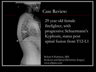 Case Review:
       29 year old female
       firefighter, with
75°    progressive Schuermann’s
       Kyphosis, status post
       spinal fusion from T12-L1


      Robert S Pashman, MD
      Scoliosis and Spinal Deformity Surgery
      www.eSpine.com
 