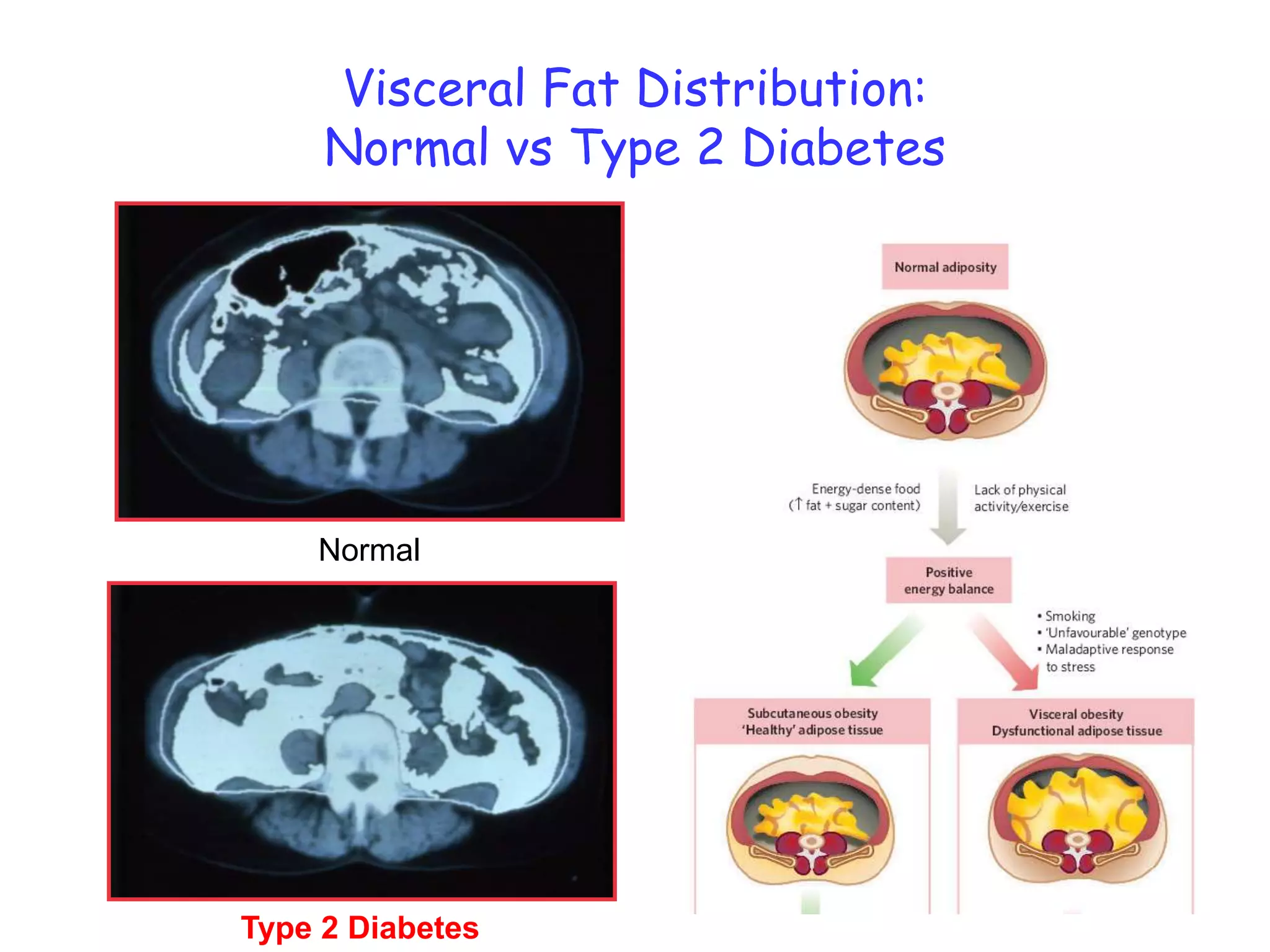 NormalType 2 DiabetesVisceral Fat Distribution:Normal vs Type 2 Diabetes