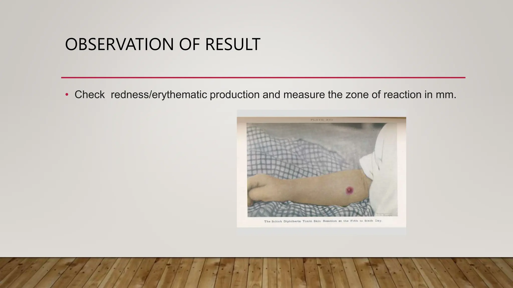 OBSERVATION OF RESULT
• Check redness/erythematic production and measure the zone of reaction in mm.
 