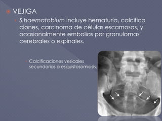  VEJIGA
› S.haematobium incluye hematuria, calcifica
ciones, carcinoma de células escamosas, y
ocasionalmente embolias por granulomas
cerebrales o espinales.
 Calcificaciones vesicales
secundarias a esquistosomiasis.
 
