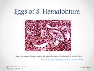 Eggs of S. Hematobium
Eggs of S. haematobium surrounded by intense infiltrates of eosinophils in bladder tissue.
https://en.wikipedia.org/wiki/Schistosoma_haematobium
14/10/2018
Pediatric Schistosomiasis
Prof. Dr. Saad S Al Ani
11
 