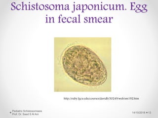Schistosoma japonicum. Egg
in fecal smear
http://ruby.fgcu.edu/courses/davidb/50249/web/sm192.htm
14/10/2018
Pediatric Schistosomiasis
Prof. Dr. Saad S Al Ani
13
 