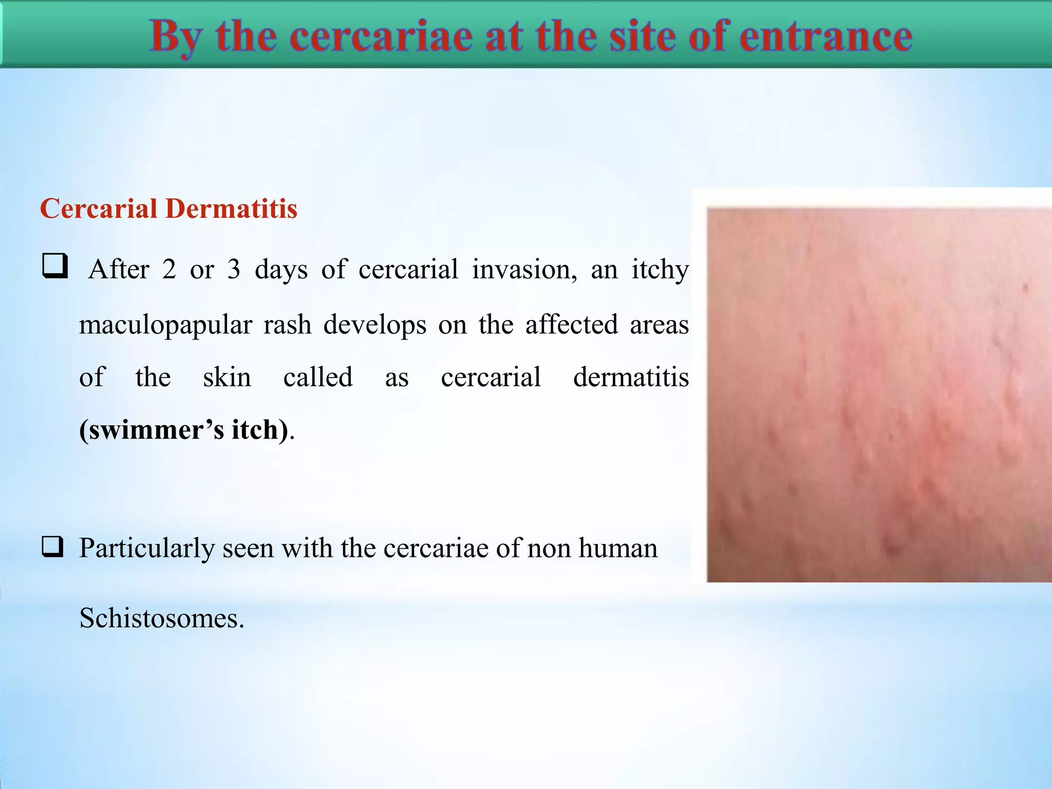 Schistosomiasis | PDF