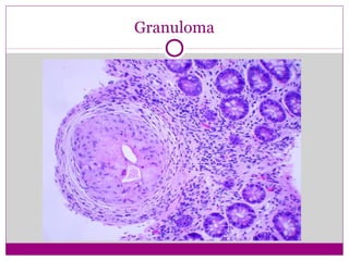 Granuloma
 