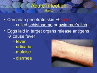 Acute Infection
(Early)
• Cercariae penetrate skin  rash
- called schistosome or swimmer’s itch.
• Eggs laid in target organs release antigens
 cause fever
- fever
- urticaria
- malaise
- diarrhea
 